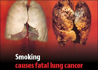 poza despre cancerul pulmonar